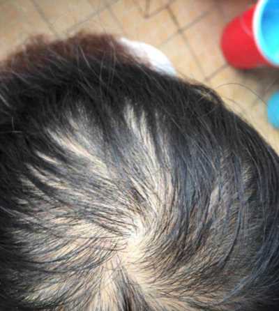 脂溢性脱发头发还能长回来吗维 脂溢性脱发头发还能长回来吗维生素B