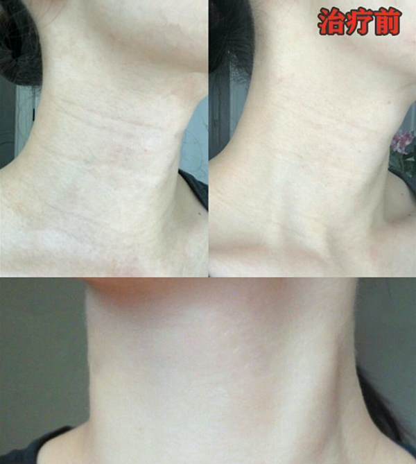 颈纹的类型 颈纹是什么样子的?