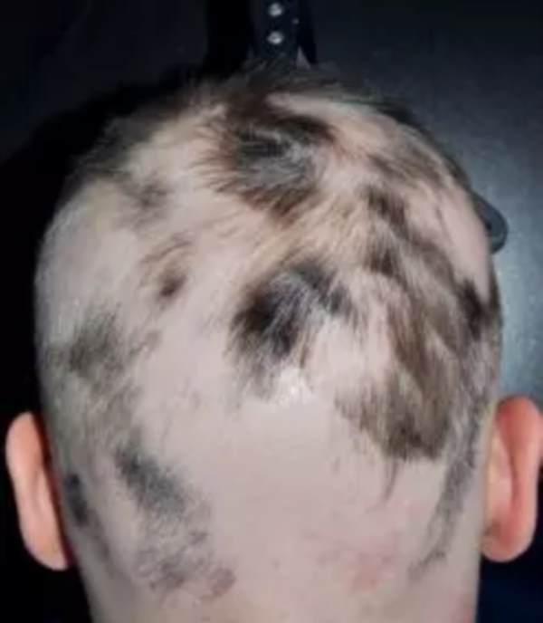 遗传性脱发怎么治疗 遗传性脱发怎么治疗有效