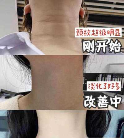 颈纹怎么消除简单方法小妙招 颈纹怎么消除简单方法小妙招视频