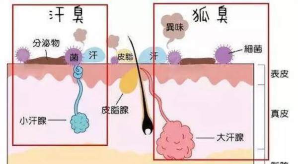 狐臭基因携带者与患者区别 狐臭基因携带者与患者区别图片