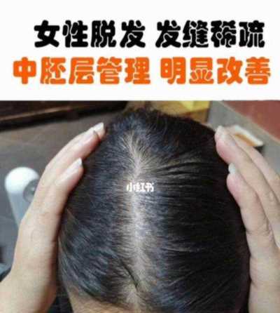 脱发治疗一般要几次 脱发治疗一般要几次能好