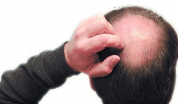 斑秃性脱发的原因有哪些 斑秃脱发的表现