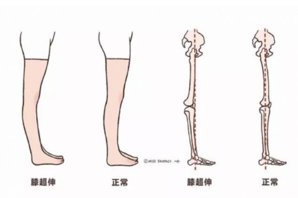 膝盖超伸怎么矫正 如何正确处理膝超伸