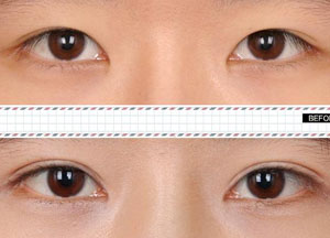 北京双眼皮手术不理想怎么办