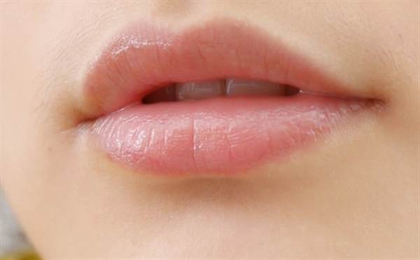 唇炎可以用红霉素软膏