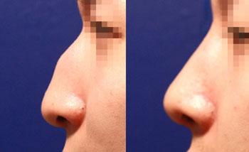 驼峰鼻整形对比图