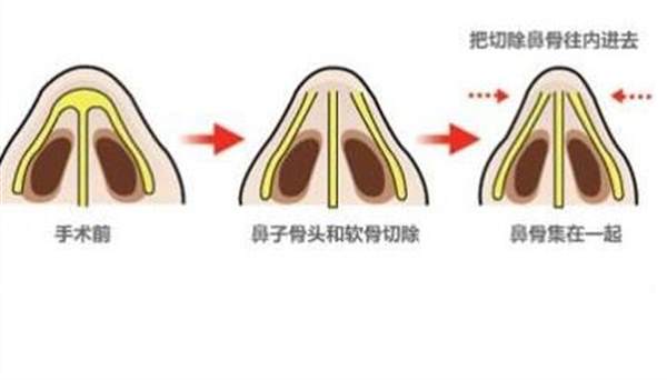 <a href=http://www.mx185.com/listinfo-751-0.html target=_blank class=infotextkey>歪鼻矫正</a>恢复过程图片