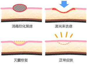 激光点痣多久能恢复