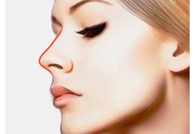 鼻子整容能维持多久
