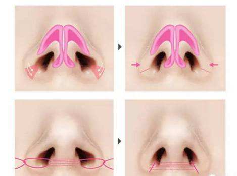 如何让鼻孔变小一点
