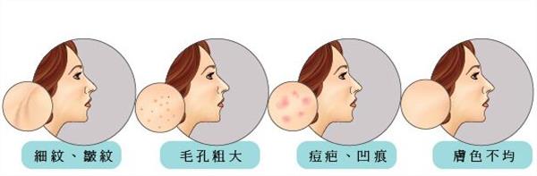 彩光嫩肤的技术方式及疗程