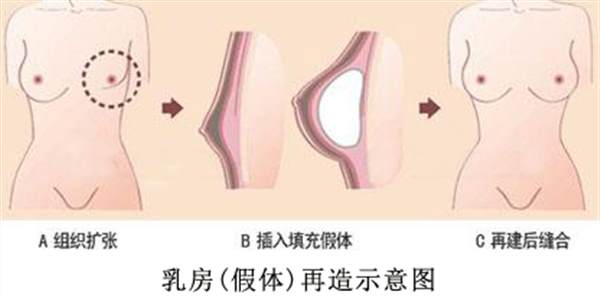 乳房再造有副作用吗