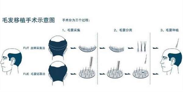 自体毛发移植价格多少