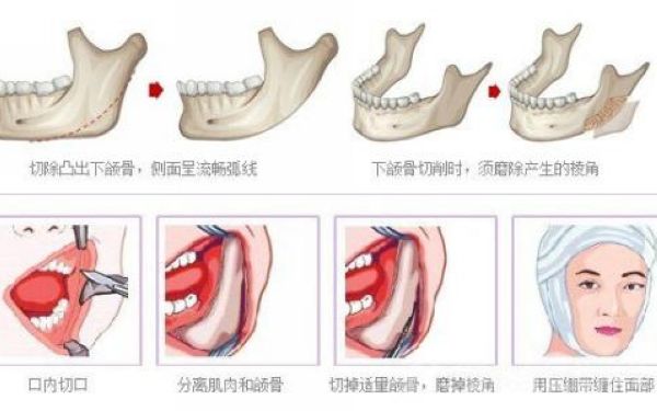 下颌骨整形危险吗