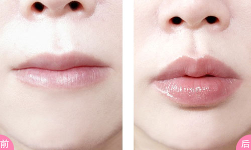 透明质酸丰唇多久能消肿