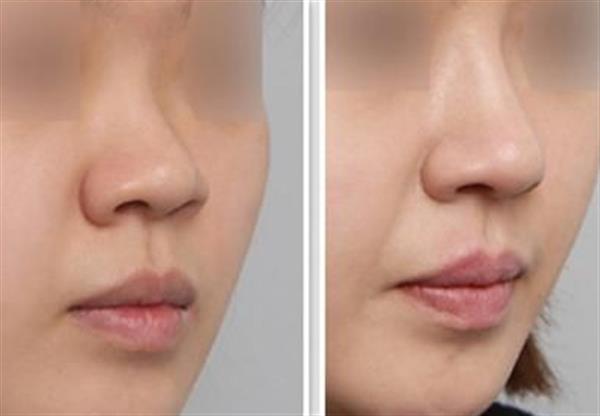 透明质酸隆鼻对比效果照片