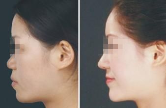 透明质酸隆鼻后鼻子会肿吗?,透明质酸隆鼻