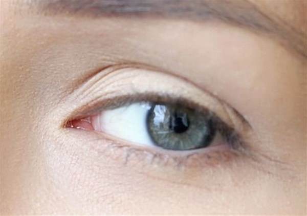 眼角皱纹用透明质酸去除怎么样