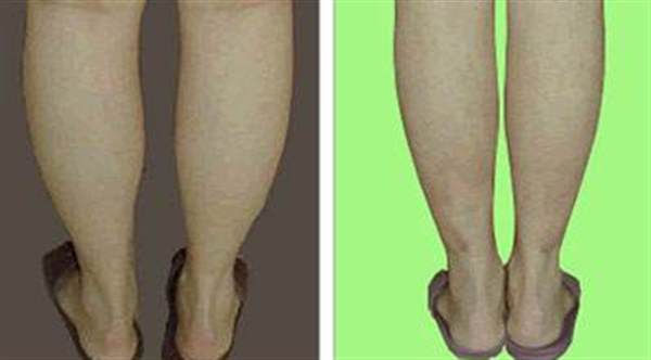 注射除皱瘦型素瘦腿有哪些优势
