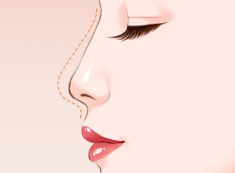 透明质酸隆鼻变宽要怎么办