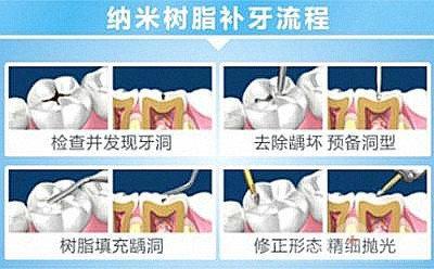 大牙补牙洞过程图解