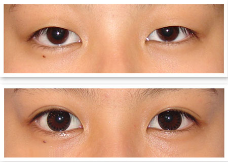韩式纳米无痕双眼皮的优势有哪些
