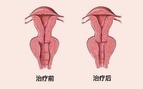 阴道紧缩术有哪些适应人群和禁忌症
