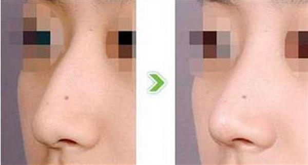 驼峰鼻矫正的效果及手术过程