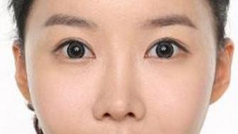 在广州做眼部整形手术多少钱