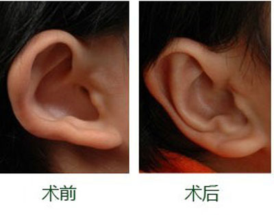 耳廓再造术的材料有哪些