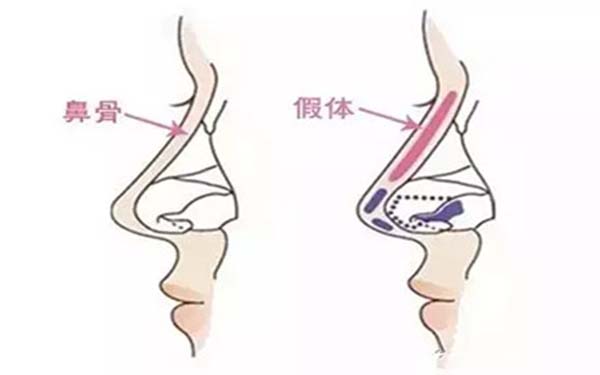 广东缩<a href=http://www.mx185.com/listinfo-754-0.html target=_blank class=infotextkey>鼻翼</a>手术费用